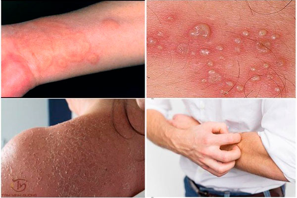 Chàm eczema là gì?