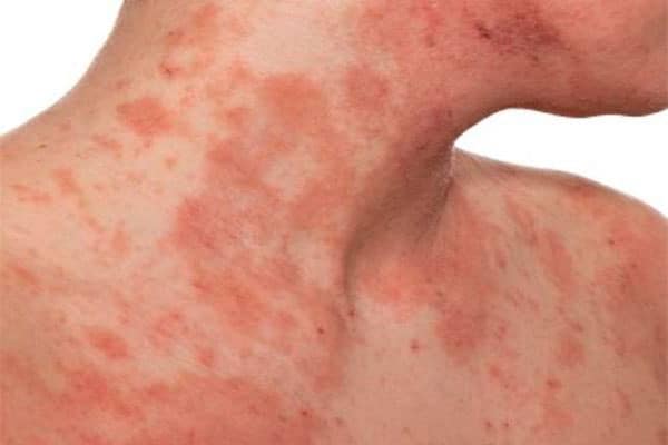 Triệu chứng chàm eczema