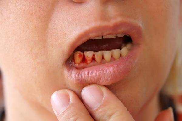 Xỉa răng gây tổn thương nướu