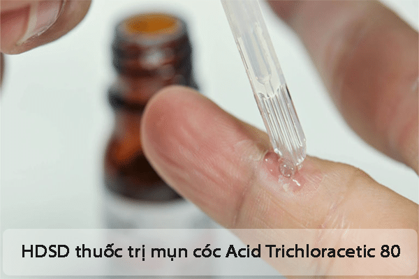 Hướng dẫn sử dụng thuốc trị mụn cóc Acid Trichloracetic 80 hiệu quả