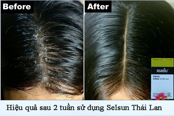 Kết quả sau 2 tuần sử dụng dầu gội Selsun Thái Lan