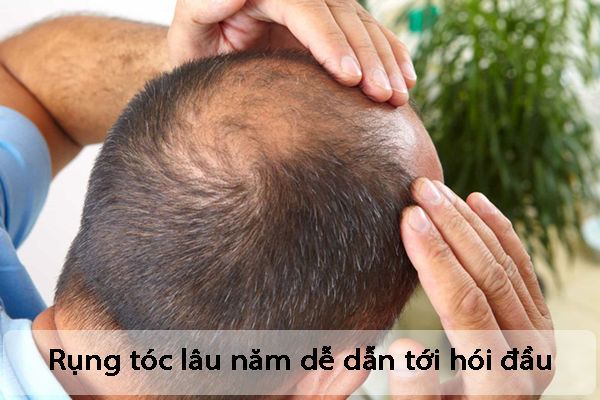 Cách chữa rụng tóc di truyền cho người bị hói lâu năm